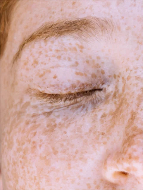 Close-up of a person's eye with visible freckles on a light skin tone.